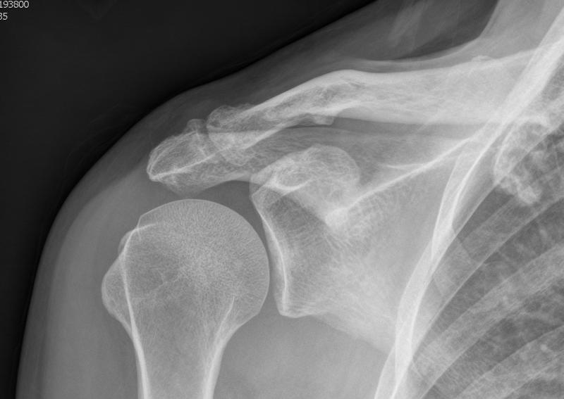 Acromioclavicular Arthritis